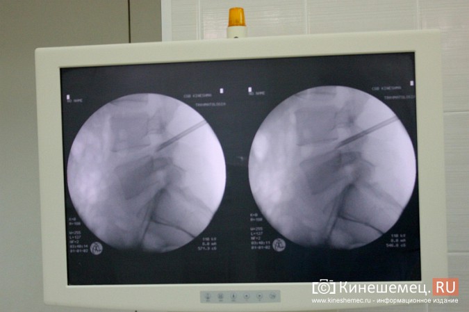 В Кинешме провели уникальные операции по удалению грыжи позвоночника фото 11