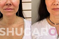 СМАС лифтинг: что это такое и как работает?