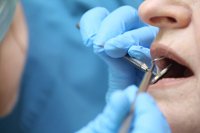 Технологии будущего: как развивается лечение кариеса в 2025 году